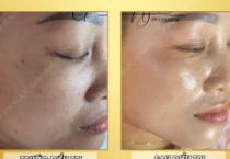 Nám thường xuất hiện ở độ tuổi nào? | Spa Ngọc Gấm