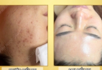 Điều Trị Mụn Hiệu Quả tại Spa Gấm Ngọc - Trị Mụn Tận Gốc