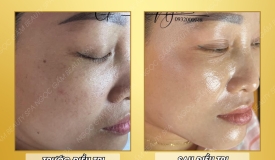 Nám thường xuất hiện ở độ tuổi nào? | Spa Ngọc Gấm