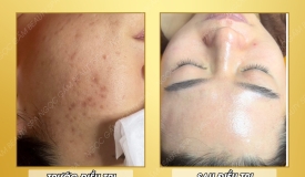 Điều Trị Mụn Hiệu Quả tại Spa Gấm Ngọc - Trị Mụn Tận Gốc