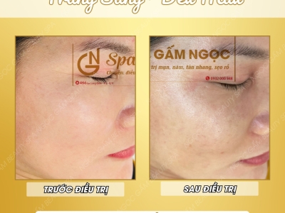 ĐIỀU TRỊ NÁM DA