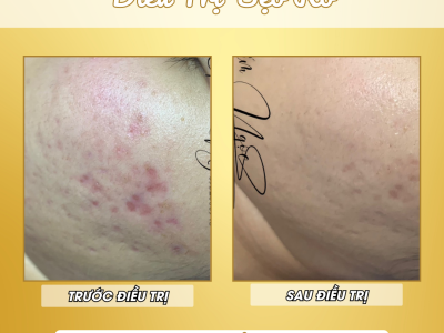 BÓC TÁCH SẸO RỖ